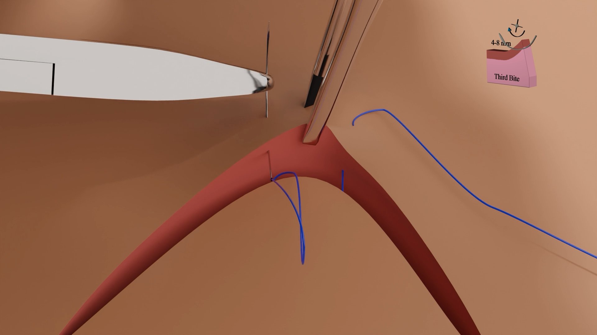 3D animation of Half Buried Horizontal Mattress Suture used in surgical training