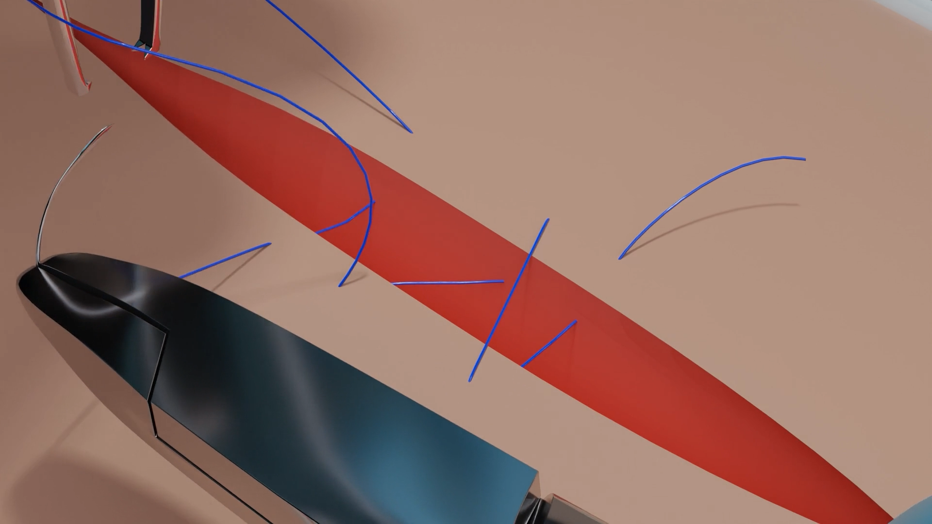 3D animation of Winch Suture used in surgical training