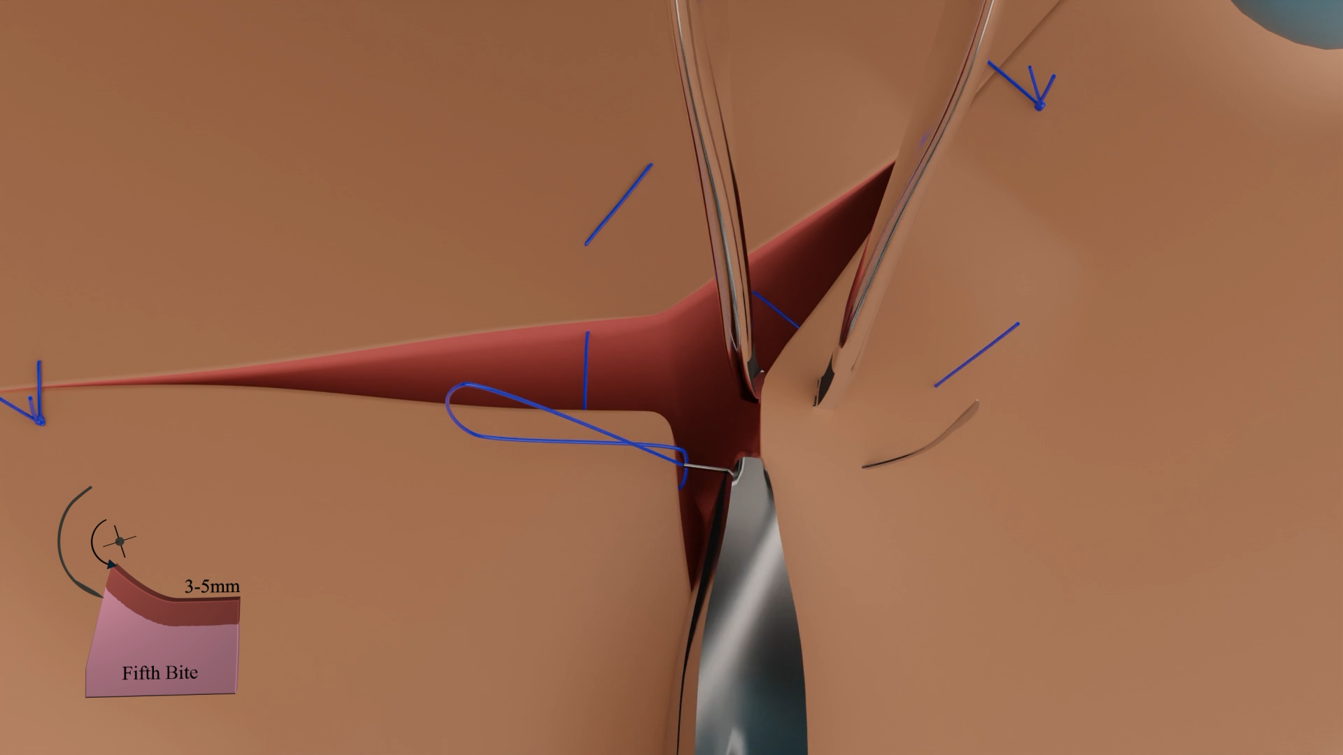 3D animation of Hybrid Mattress Suture used in surgical training
